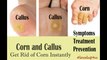 corns and calluses|painful corn|corn in leg reason|corn treatment|corns and calluses home remedies|corn surgery| corn yoga|