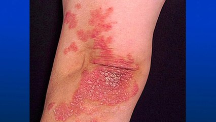 bd-hablamos-de-artritis-psoriasica-140720