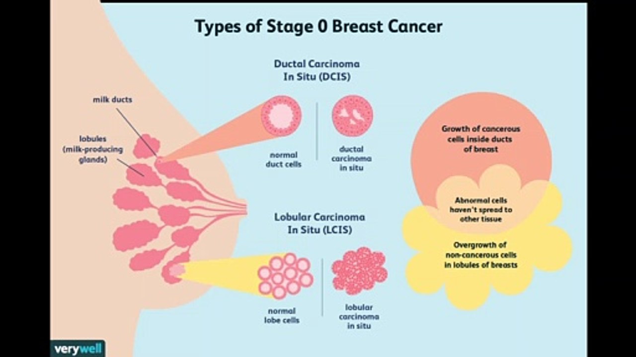 Treatment of Ductal Carcinoma in Situ
