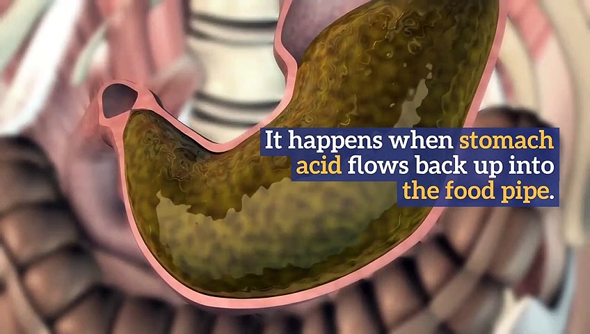 Natural Remedies For Acid Reflux