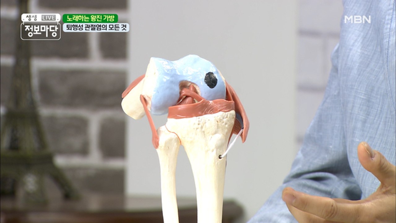 퇴행성 관절염, 인공관절 수술 외 치료법