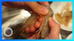 Jari pria terinfeksi bakteri pemakan daging setelah terluka saat kupas kulit udang - TomoNews