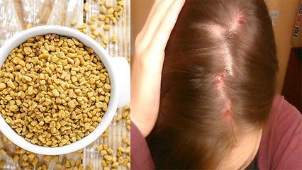 Pimples on Scalp: सिर में होने वाले मुंहासे-फुंसियों का ऐसे करें इलाज,दोबारा नहीं होगी तकलीफ।Boldsky