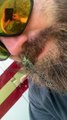 Dragonfly Munches on Meal in Man's Mustache