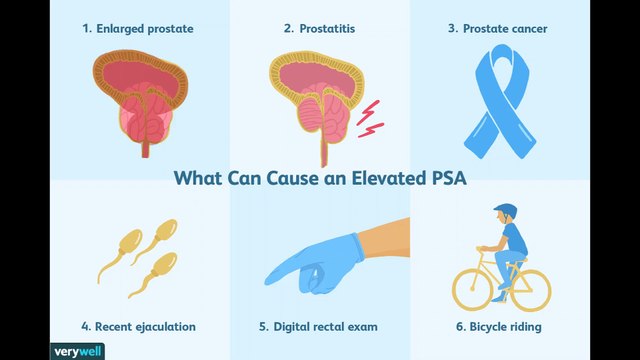 Following PSA Levels During and After Prostate Cancer Treatment