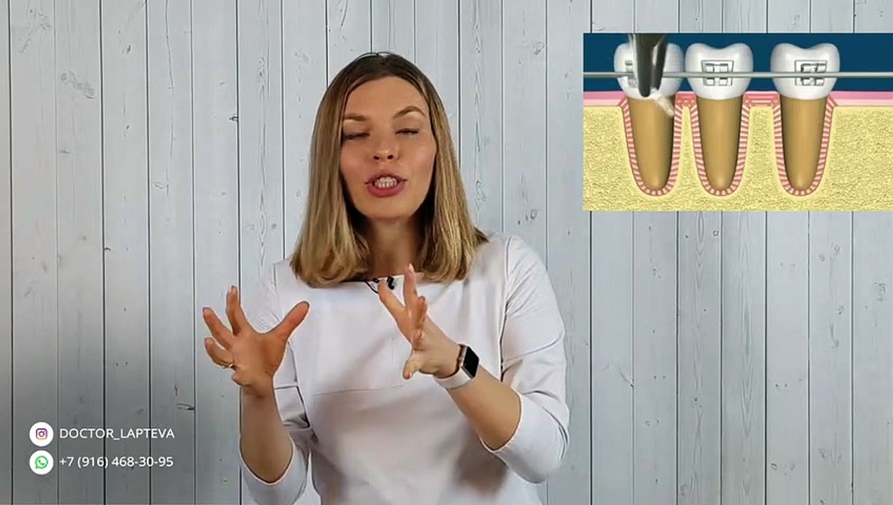 От брекетов шатаюстся зубы?