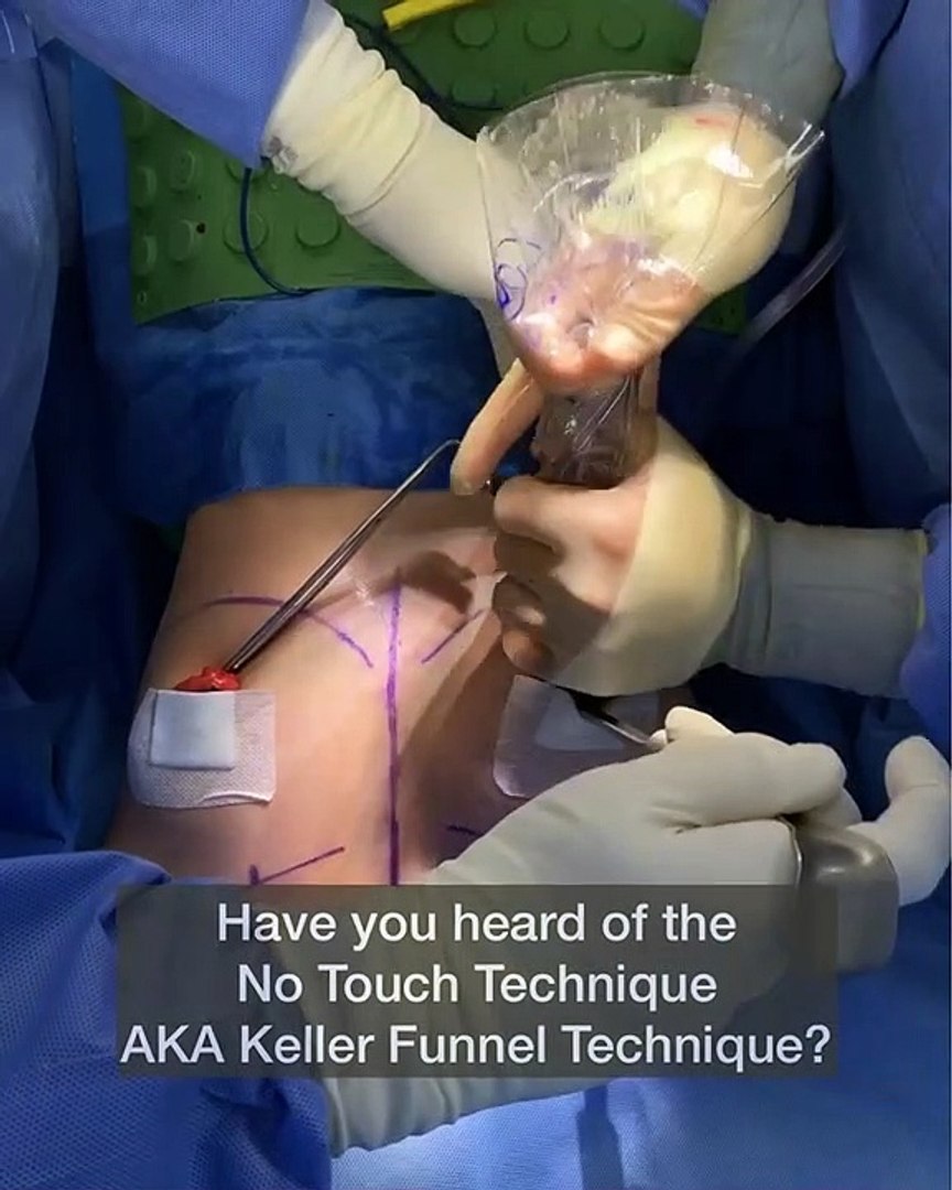 ⁣Keller Funnel Surgery - Beverly Hills Plastic Surgery Inc