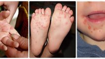 Quảng Ninh: Số ca mắc tay chân miệng tăng đột biến