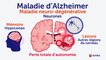 Alzheimer : symptômes, facteurs de risque, traitements