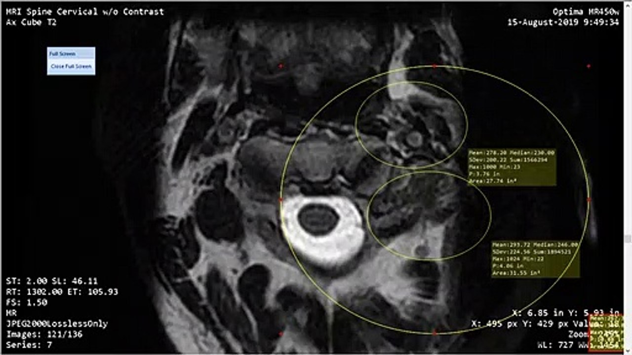 Part 2 Told Parasites / Infection Was "Stress" Northside Medical St. Vincents Primary Trussville