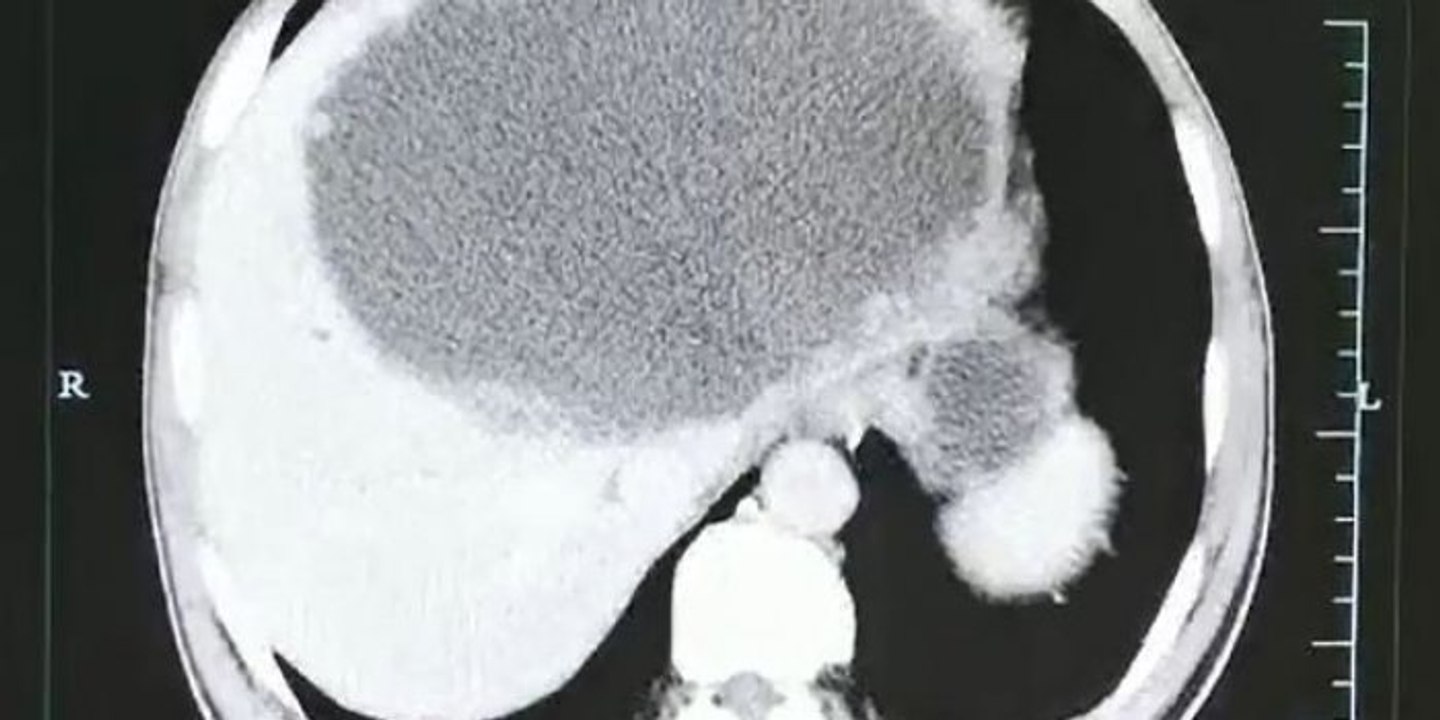 Après avoir mangé du poisson cru, il a eu le foie infesté de vers