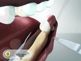Bone Augmentation - Bone Grafting - Dental Implants Asia