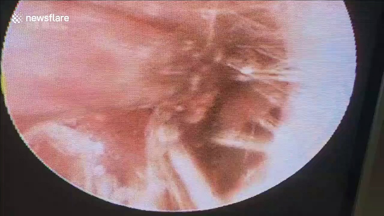 Doctor removes living butterfly from man's ear in Vietnam