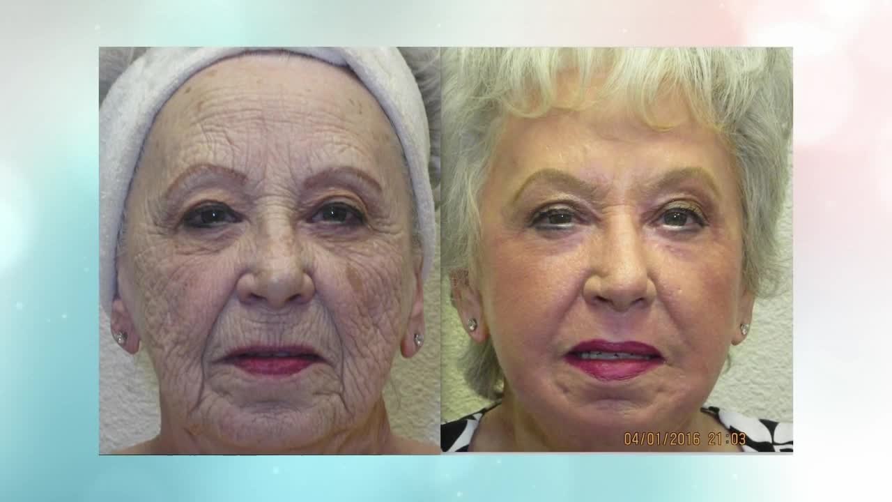 Get ready to look decades younger with Renuvion...