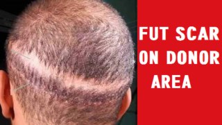5 Major Benefits Of FUE (Follicular Unit Extraction) Hair Transplant Surgery | FUT Or FUE Which Is Best?