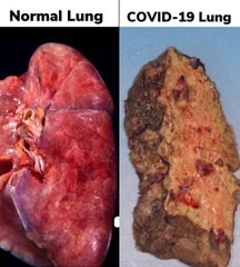 La photo d'un  poumon dévasté  par le Covid-19 fait  douter des  internautes,  mais elle est authentique