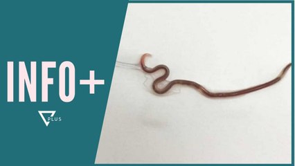 INFO+ / Ankohej për dhimbje fyti, mjekët i gjejnë krimbin 10cm në fyt - Vizion Plus