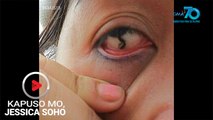 Kapuso Mo, Jessica Soho: Babae, pinasukan ng buhay na linta sa kanyang mata!