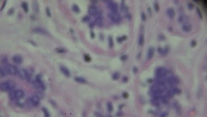 New Cheap & Fast Breast Cancer Test Appears To Be 100% Accurate