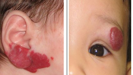 Bé gái có khối u máu ở tai hiếm gặp | VTC