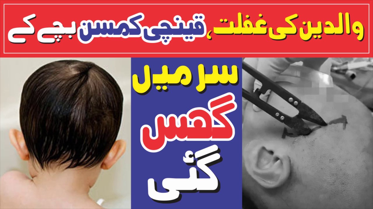 Due To The Negligence of The Parents, The Scissors Penetrated The Child's Head