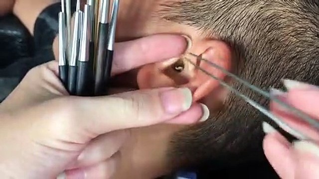 You will be stunned by what came out of ears| कान में से जो निकला उसे देखकर आप दंग रह जाएंगे