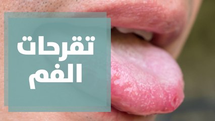 حساسية القمح هي أحد أسباب تقرحات الفم المتكررة..التفاصيل مع د.محمد رشيد