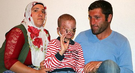 Cilt kanseri 8 yaşındaki Salih, gün ışığına çıkamıyor