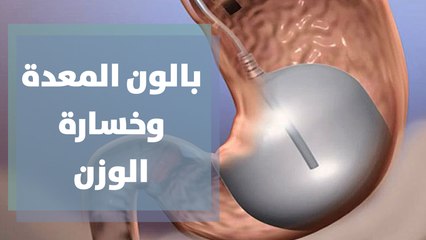 هل يؤدي بالون المعدة إلى خسارة الوزن؟