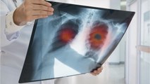 Study: The Most Common Form Of Lung Cancer Is Killing Fewer People In The US