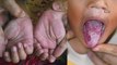 Terengganu health dept says 14 more preschoolers contracted HFMD