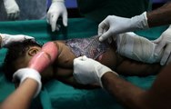 Brazilian doctors use tilapia fish skin to treat burn victims
