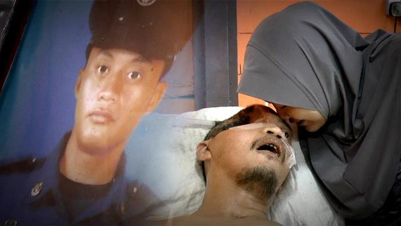 Accident leaves man with half a skull
