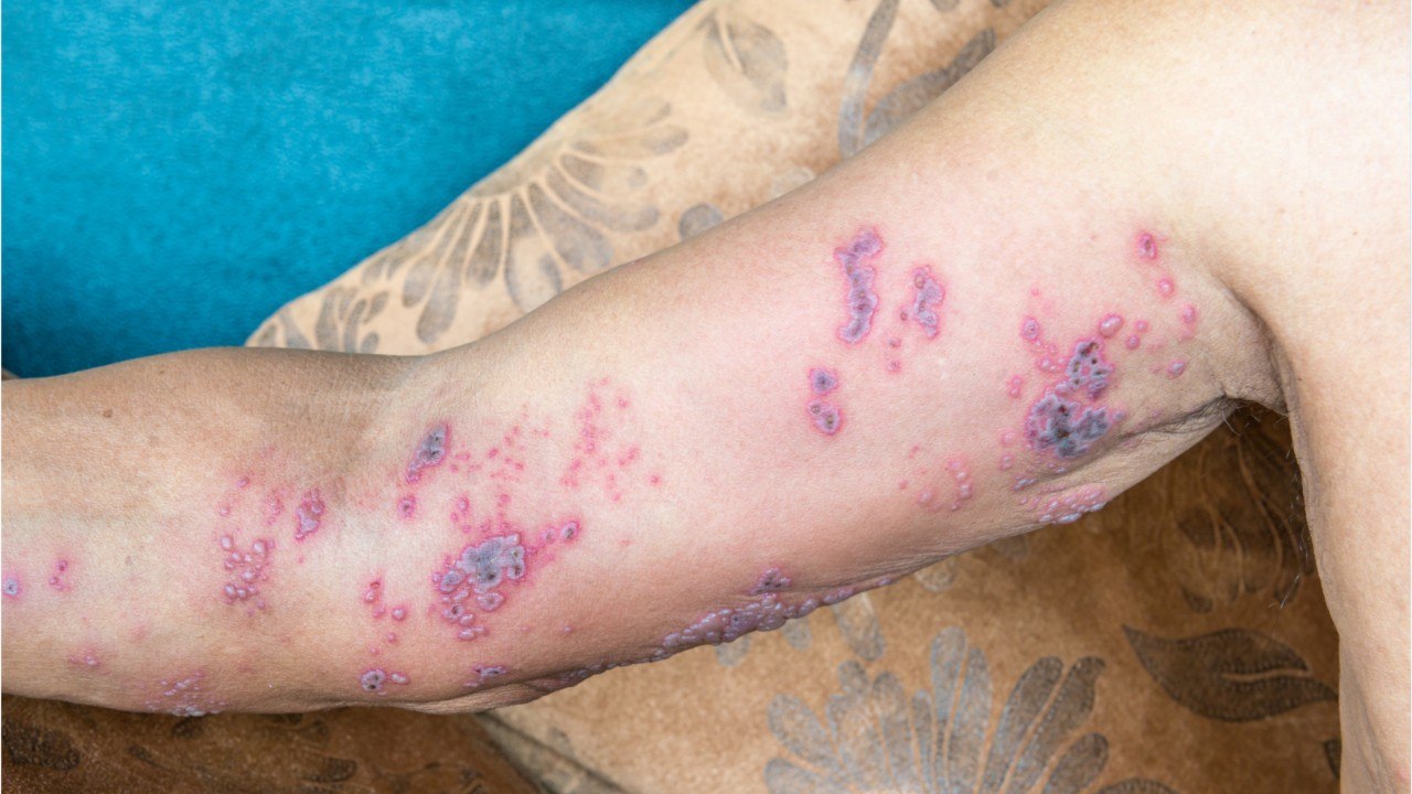 The Stages of Shingles