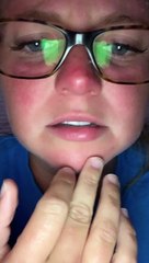 Medicine Side Effects Lead to Extreme Swelling
