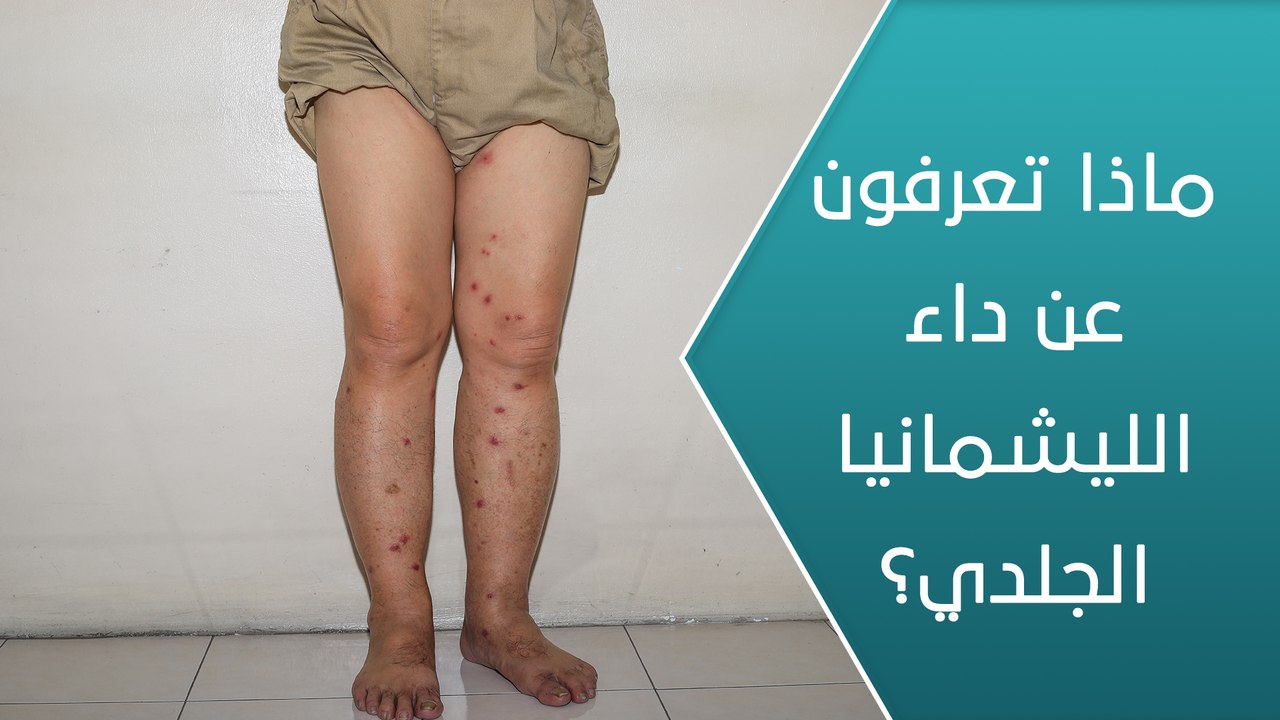 ماذا تعرفون عن داء الليشمانيا الجلدي؟ - العيادة