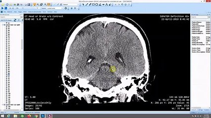 St. Vincent's East Cropped My Head CT And Cut Out Broken Skull Part 2
