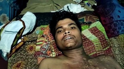 मोबाइल की बैटरी फटने से रिपेयरिंग का कार्य करने वाला व्यक्ति गंभीर घायल, अस्पताल में इलाज जारी