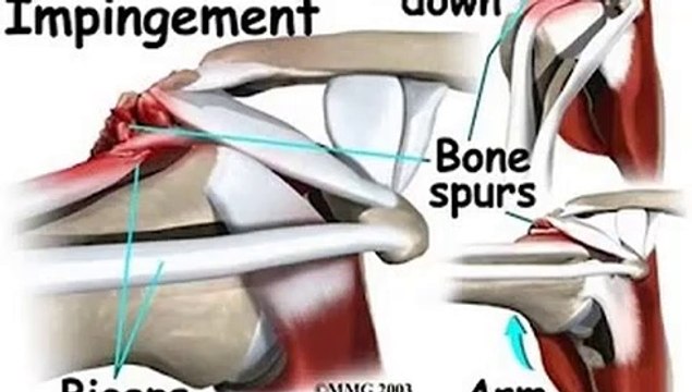 Shoulder Impingement - Signs and symptoms
