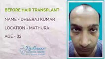 Hair Transplant Testimonials   Before and After   Hair Transpation Surgery India Delhi Testimonials