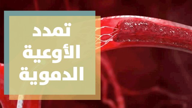 تعرفوا على أعراض (أم الدم) أو ما يعرف بتمدد الأوعية الدموية