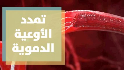 تعرفوا على أعراض (أم الدم) أو ما يعرف بتمدد الأوعية الدموية