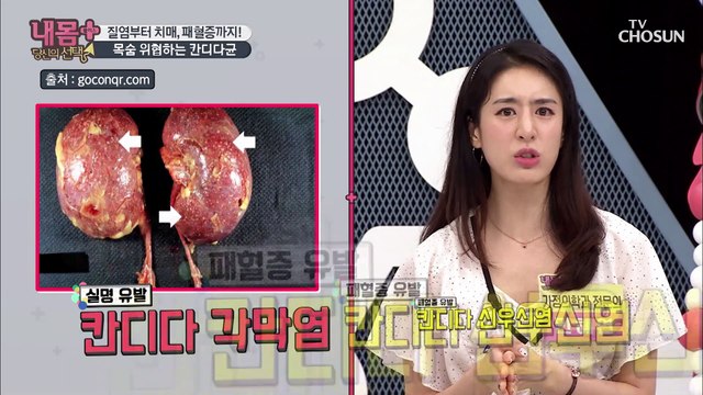 달달한 음식 당기면 ‘치매 유발’ 곰팡이 증가 신호!