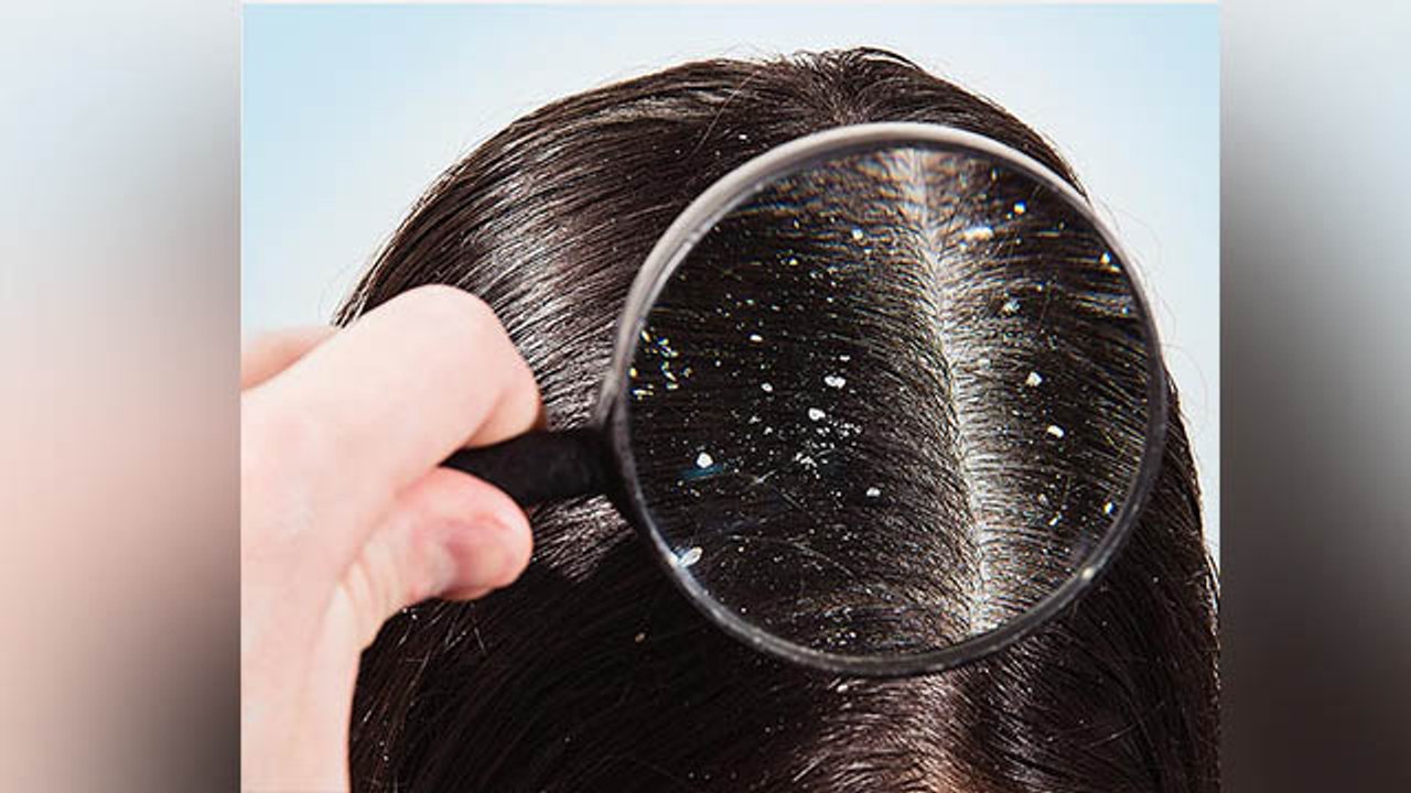 Hair Care : सालों पुराना Dandruff भी होगा छूमंतर । बस नारियल तेल में मिलाएं ये चीज । Boldsky