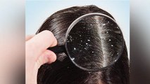 Hair Care : सालों पुराना Dandruff भी होगा छूमंतर । बस नारियल तेल में मिलाएं ये चीज । Boldsky
