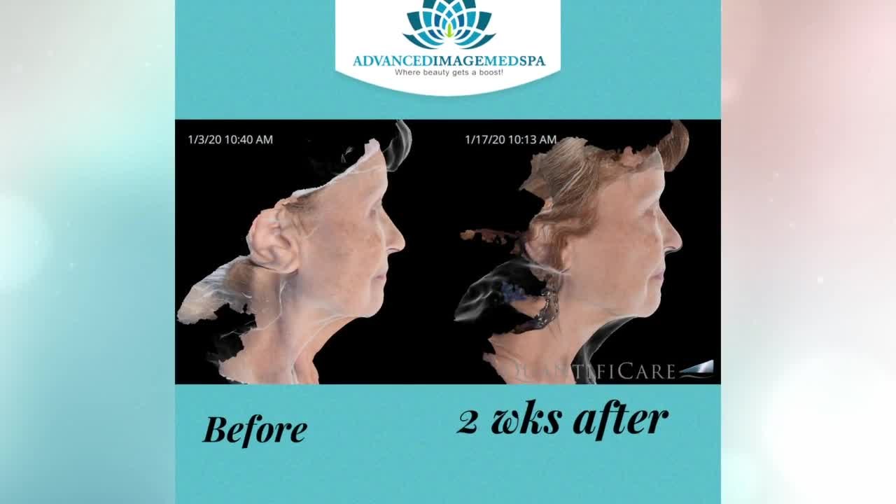 Look decades younger with Renuvion from Advance...