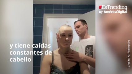 Hombre afeitó su cabeza para quedar igual que su novia con alopecia