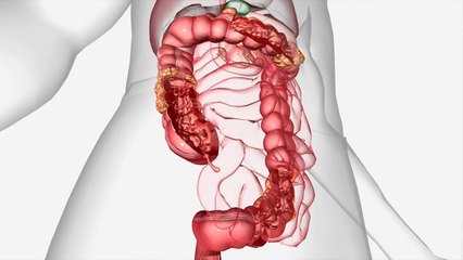 bd-complicaciones-de-apendicitis-310820