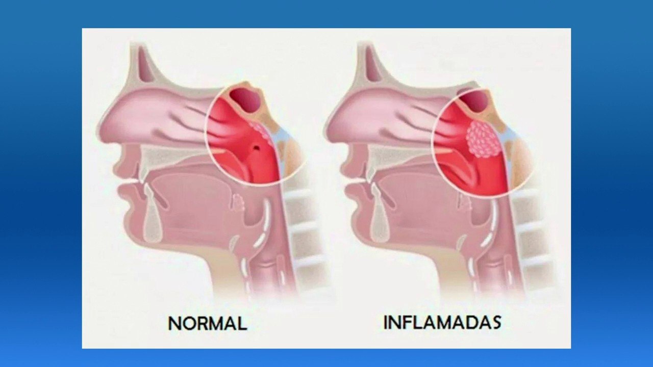 bd-causas-y-tratamientos-para-las-adenoides-inflamadas-010920