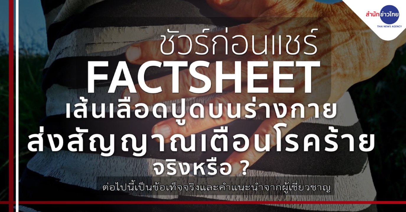 ชัวร์ก่อนแชร์ FACTSHEET : เส้นเลือดปูดบนร่างกาย ส่งสัญญาณเตือนโรคร้าย จริงหรือ ?